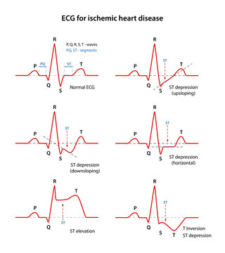 ECG for coronary heart disease. Types of coronary heart disease. Cardiogram of the heart. Vector illustration in flat style