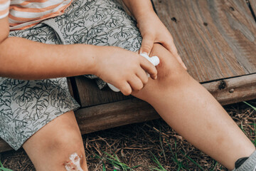 child's leg injury. child injured his knee when he fell off close up. The boy uses an antibacterial agent to treat the wound