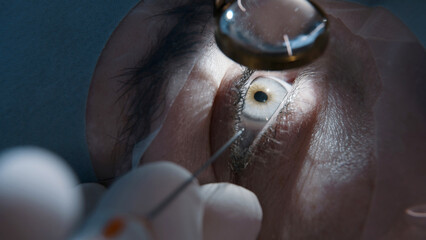 Open eye. Patient under sterile cover. Close-up. Laser vision correction. Patient and surgeon in...