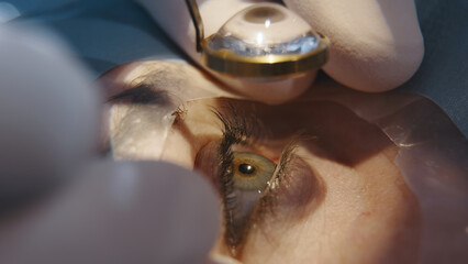 Open eye. Patient under sterile cover. Close-up. Laser vision correction. Patient and surgeon in...