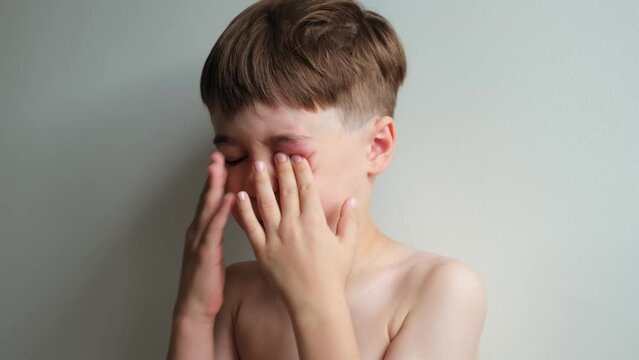 The boy rubbing his swollen eye from an insect bite. Close-up portrait looking at the camera. Angioedema. Allergic response. Red inflamed upper eyelid. Inflammation. Itching bites. The tired child