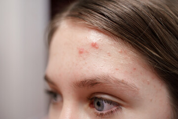 Naklejka premium Teenage pimples on the forehead of a young girl