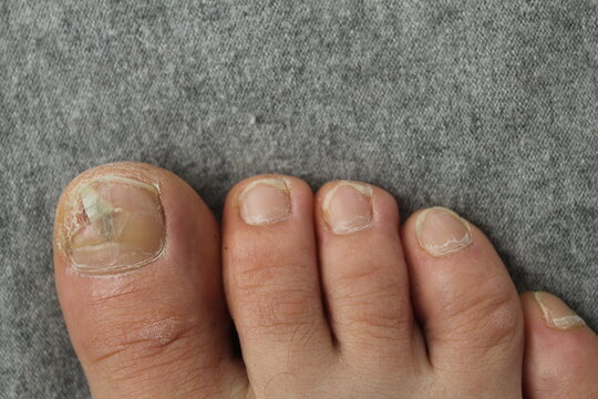 Damaged toenail plate close-up. Nail and skin diseases fungus