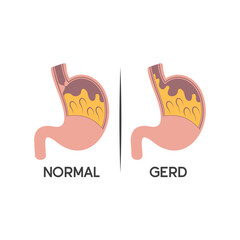 illustration of Gastroesophageal reflux disease or GERD.