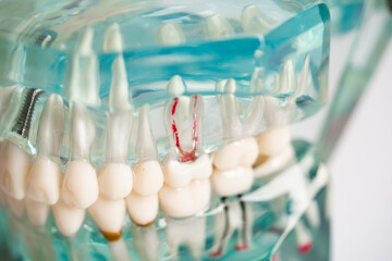 Dental implant, artificial tooth roots into jaw, root canal of dental treatment, gum disease, teeth model for dentist studying about dentistry.
