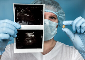 Concrement withdrawn from the kidney with an ultrasound in the doctor's hands. Human urolithiasis. Phosphate or oxalate kidney stone. Urologist surgeon demonstrates a kidney stone. Doctor 