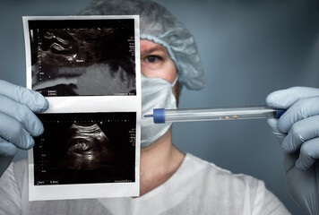 A calculus from a human kidney in a medical case, an ultrasound of the ureter in the doctor's hands. Human urolithiasis. Phosphate or oxalate kidney stone. Urologist surgeon a kidney stone