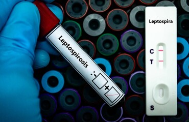 Blood sample of patient positive tested for leptospirosis by rapid diagnostic test.