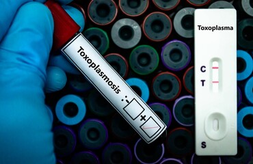 Blood sample of patient positive tested for toxoplasmosis by rapid diagnostic test.