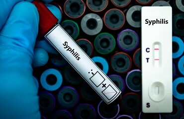 Blood sample of patient positive tested for syphilis by rapid diagnostic test.