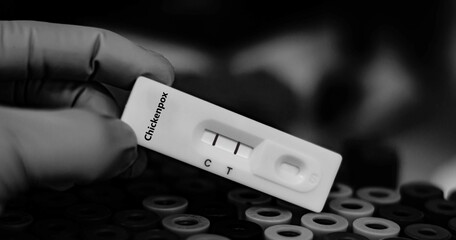 Blood sample of patient positive tested for chickenpox virus by rapid diagnostic test.