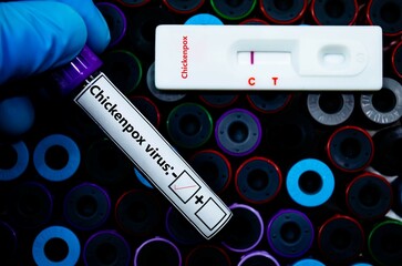 Fototapeta premium Blood sample of patient negative tested for chickenpox virus by rapid diagnostic test.