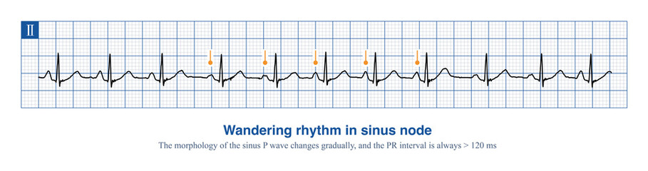 When the dominant pacemaker of the sinus node changes within the sinus node, the morphology and frequency of sinus P waves change, resulting in a wandering rhythm.