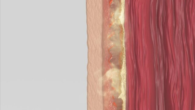 3D cross section show fat burning under the skin
