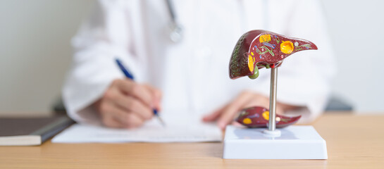 Doctor with human Liver anatomy model. Liver cancer and Tumor, Jaundice, Viral Hepatitis A, B, C,...