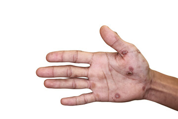 Close up of Secondary stage syphilis sores (lesions) on the palms of the hand. Referred to as...