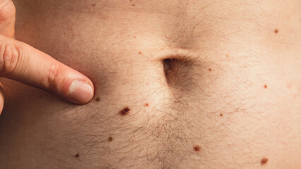 Male hand showing birthmarks on skin body stomach part. Close up detail of the bare skin. Health...