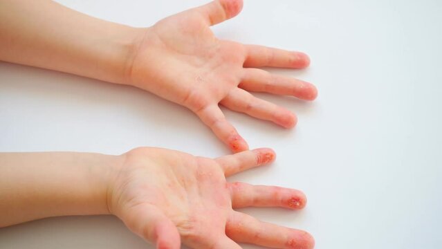 Dyshidrosis. Close-up of children's hands with dyshidrosis on a white background.
