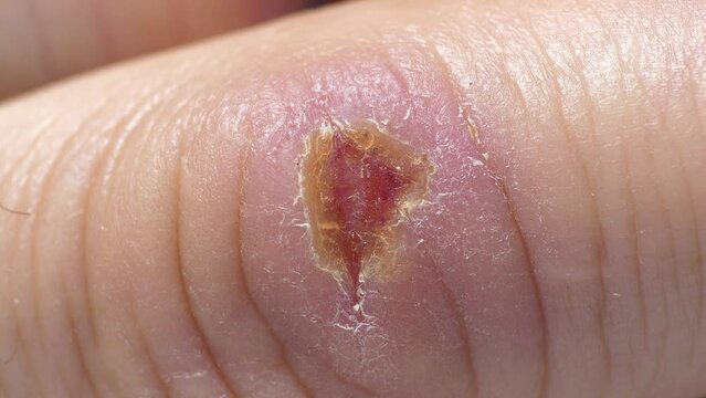 Wound is healing. Self-healing of body. Ten days after injury. There was an injury to middle finger of right hand with bleeding. 4K macro shot video