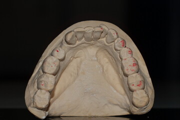 dental technician model removable prosthesis PAPM cobalt chrome resin wax tooth denture frame