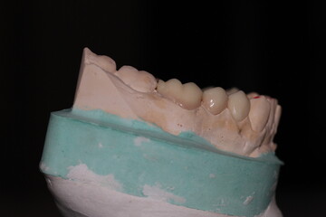 dental technician model fixed prosthesis ceramic wax up plaster crown ceramo ceramic CCM