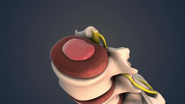 Herniated disc of the lumbar spine