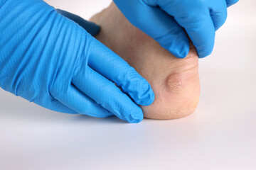 A doctor examines calluses on a man's feet. Treatment of corns on the feet.