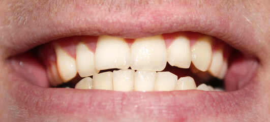 Close-up of a guy's healthy smile. White clean teeth. Stock photo of treatment at the dentist.