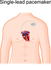 Single lead pacemaker placement. Сross section of heart and artificial cardiac pacemaker.