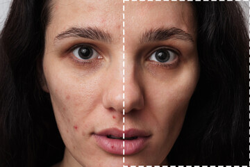 A close-up shot of the face of a young woman with skin problems - pimples, acne, enlarged pores....