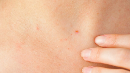 woman concerns irritated skin on the neck. skin with allergic reactions, acne. Care and treatment...