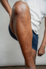 Fototapeta na wymiar Man showing leg with scars against gray background