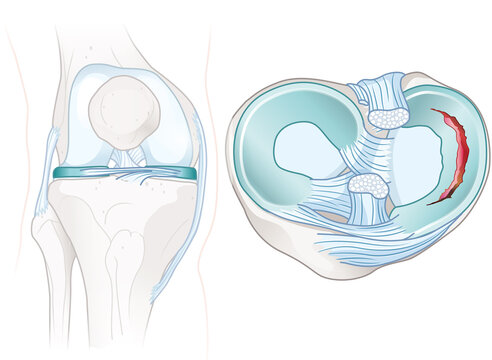 Meniscus tears anatomy. Medically illustration