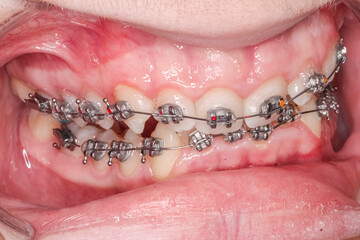 Oblique lateral view of dental arches, misaligned biting teeth with anterior deep bite malocclusion, orthodontic braces, arch wire, crooked teeth, cheeks and lips retracted with cheek retractor. © MSC
