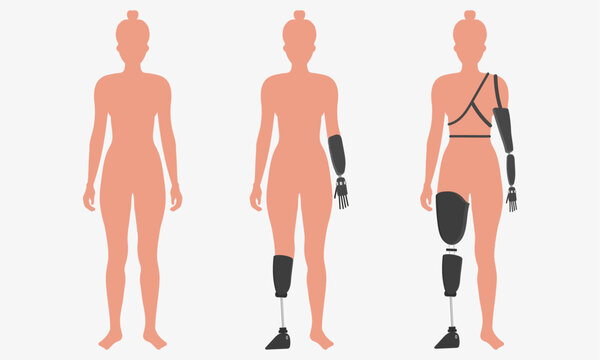 Disabled woman wearing innovative exoskeleton, Artificial limb leg, prosthesis