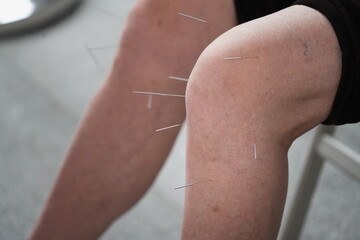 Close-up of a person receiving acupuncture treatment in a medical practice