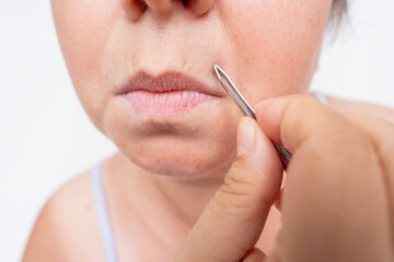 adult woman pulls out, removes with metal tweezers excess hairs on face near lips, close-up of...