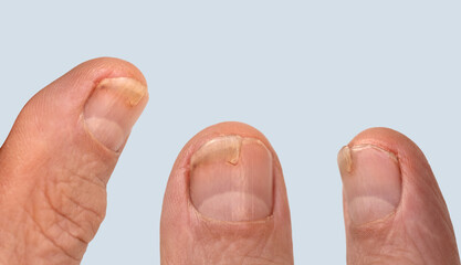 injured finger, nail damage from impact, compression, tear, part of male finger injury close-up,...