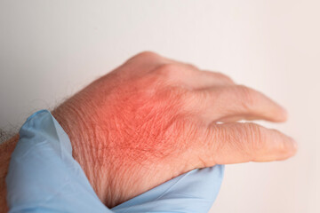 hand elderly man with inflamed tendon from rheumatism, doctor palpating patient's painful palm,...