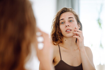 Young woman with pimples on her face. Life with acne. Problem skin prone to rashes and acne, scars....