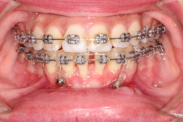 Orthodontics teeth alignment treatment with braces and elastic ligatures, anterior diastema gap...