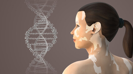 Leukoderma or Vitiligo caused by hormonal imbalance medical animation - obrazy, fototapety, plakaty