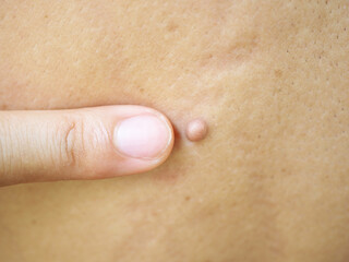 Fototapeta premium Pink mole on back asian man of skin lesion case of proliferation of pigment derma cells and melanocytic pigmented naevus. Closeup photo, blurred.