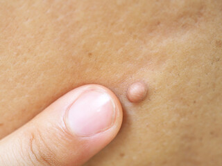 Pink mole on back asian man of skin lesion case of proliferation of pigment derma cells and melanocytic pigmented naevus. Closeup photo, blurred.