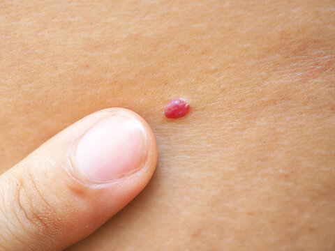 Man points a finger at a large mole on his back. Closeup photo, blurred.
