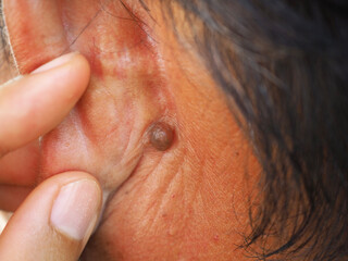 Man pointed to sebaceous cysts on his neck, formed by sebaceous glands. Oils called sebum and laser skin treatments or flea biopsies health concept. closeup photo, blurred.