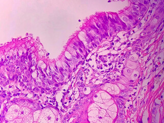 ciliated epithelium in ovarian teratoma 40x