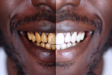 dental whitening, Before and after dental whitening close up radiant smile evolution transformation, close up of a person with a smile, white smile