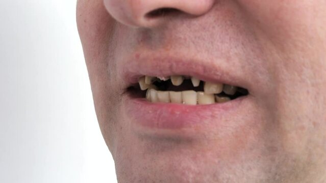 Close-up of adult male with dental health issues, missing teeth visible.