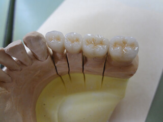 歯科技工のメタルボンドとレジン模型・きれいに並んだ白い歯